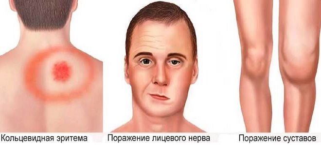 клещевой боррелиоз клещевой боррелиоз