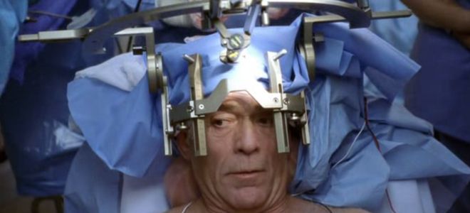 краниотомия в сознании краниотомия в сознании