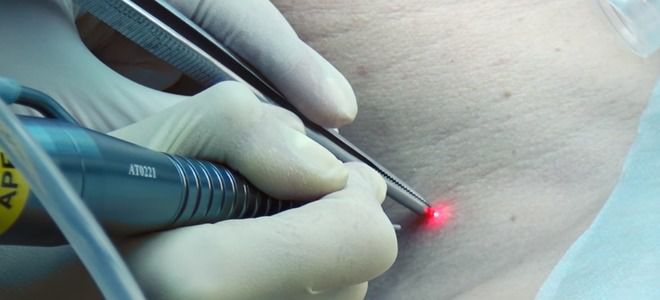 лазерный аппарат для удаления папиллом лазерный аппарат для удаления папиллом