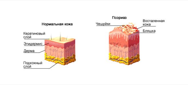 лечение псориаза лечение псориаза