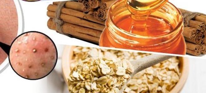 маски от прыщей в домашних условиях рецепты маски от прыщей в домашних условиях рецепты