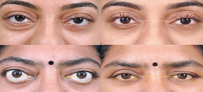 офтальмопатия при тиреотоксикозе офтальмопатия при тиреотоксикозе