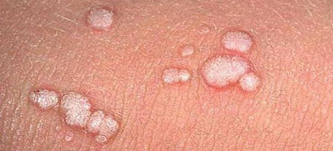 плоские кондиломы у женщин плоские кондиломы у женщин