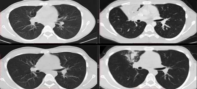 показывает ли кт коронавирус показывает ли кт коронавирус