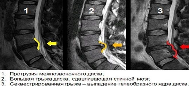 фото3 протрузия позвонков