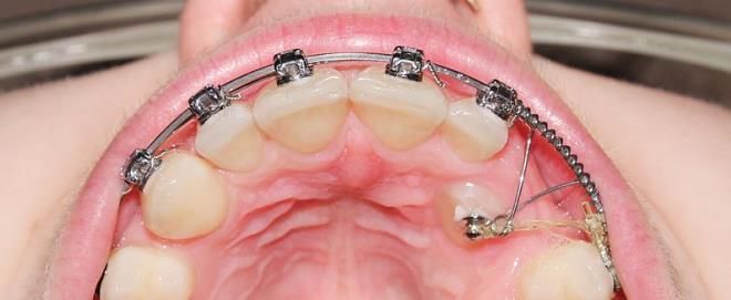 ретинированный зуб брекеты ретинированный зуб брекеты