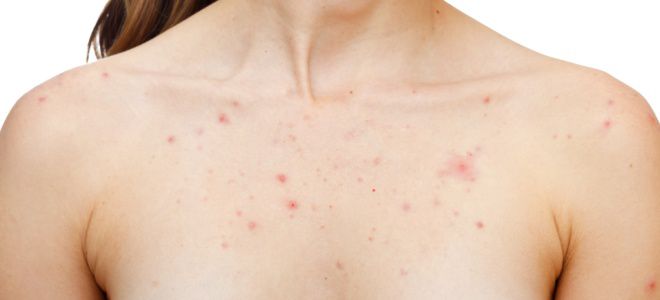 Стафилококк на теле сыпь Стафилококк на теле сыпь