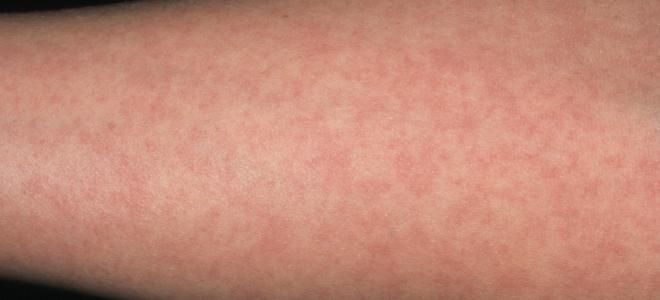 Сыпь при детских инфекциях краснуха Сыпь при детских инфекциях краснуха