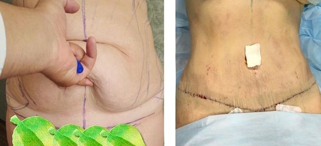 Абдоминопластика послеоперационный период раз Абдоминопластика послеоперационный период раз