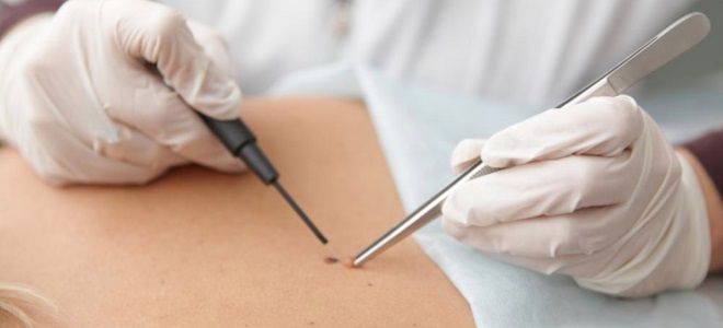 что делать после удаления папилломы что делать после удаления папилломы