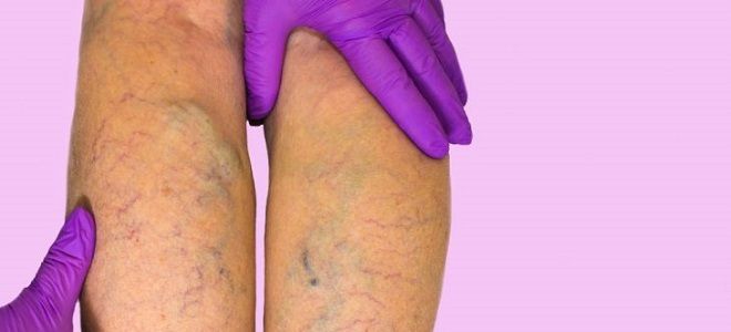 что лечит флеболог что лечит флеболог