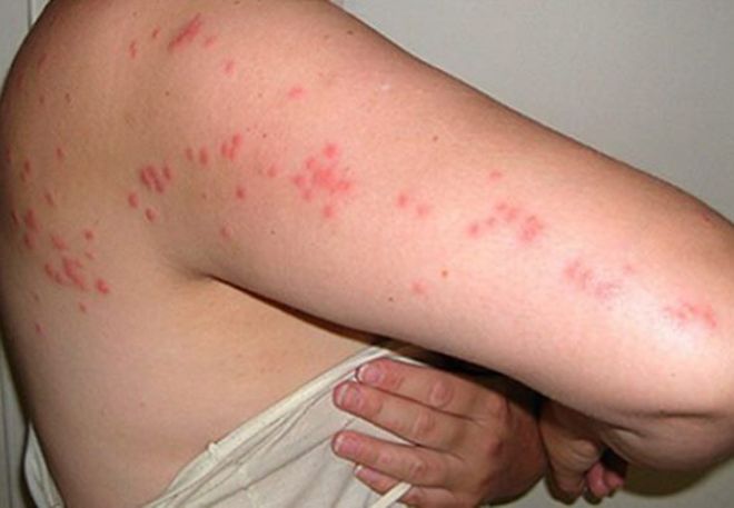 как кусают постельные клопы как кусают постельные клопы