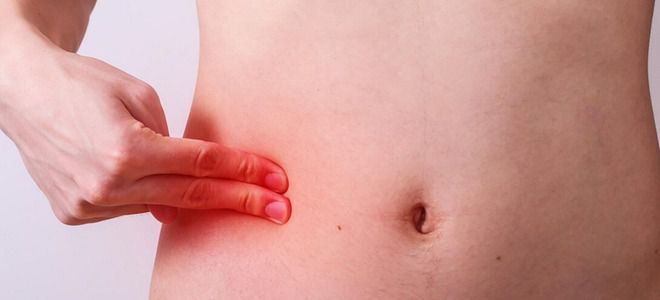 как определить воспаление аппендикса как определить воспаление аппендикса