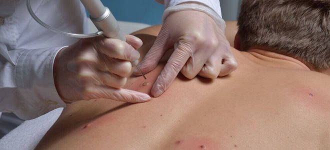 можно ли удалить монгольское пятно можно ли удалить монгольское пятно