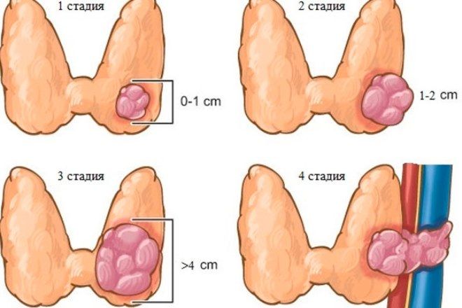 признаки рака щитовидной признаки рака щитовидной