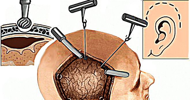 трепанация черепа последствия трепанация черепа последствия