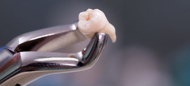 удаление ретинированного зуба удаление ретинированного зуба