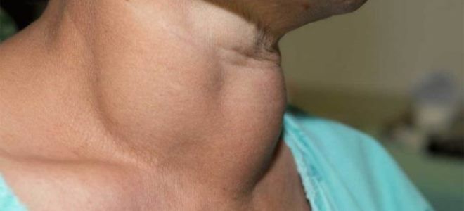 щитовидная железа рак щитовидная железа рак