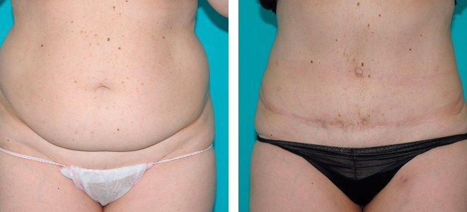 Абдоминопластика реабилитационный период раз Абдоминопластика реабилитационный период раз