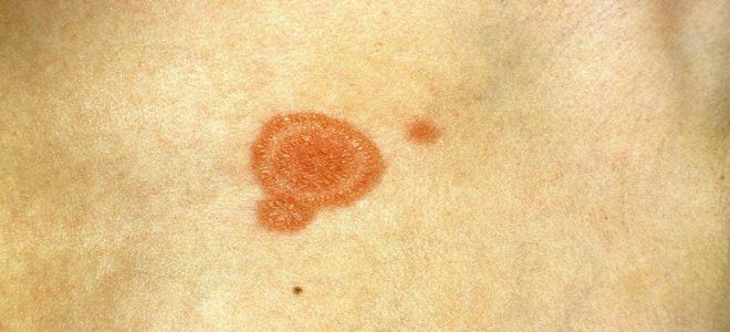 каламин от лишая каламин от лишая