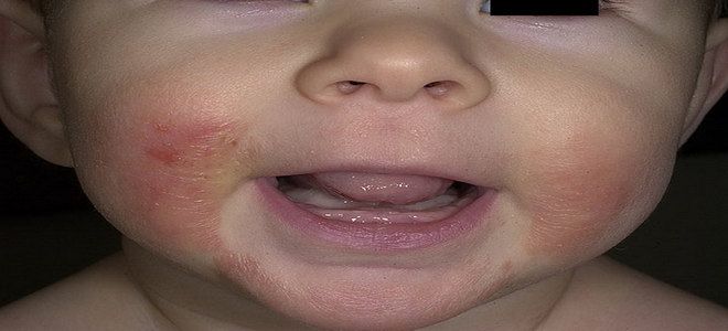 каламин при атопическом дерматите каламин при атопическом дерматите