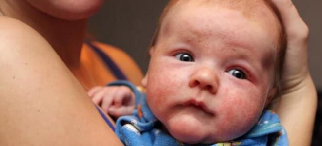 экссудативно катаральный диатез у детей характеризуется поражением экссудативно катаральный диатез у детей характеризуется поражением