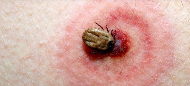 как лечить укусы клопов как лечить укусы клопов