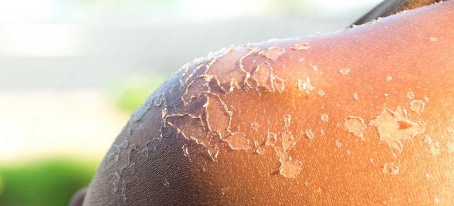 каламин при ожогах каламин при ожогах