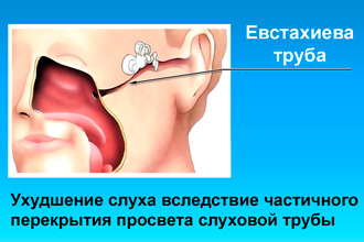 Ухудшение слуха Перекрытие просвета слуховой трубы