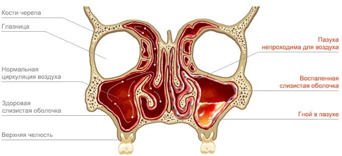 Одонтогенный гнойный гайморит провоцируется воспалением зубов Почему возникает гнойный гайморит
