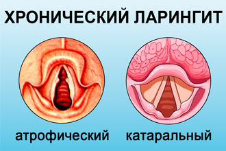 Хронический ларингит Типы хронического ларингита