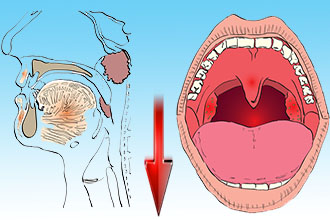 Уменьшение отечности лимфаденоидных образований Свойства согревающих аппликаций