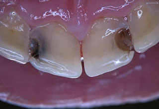 Причина «зубного» гайморита Кариес верхних зубов