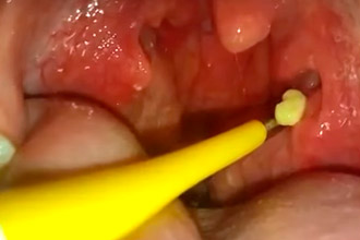 Пробки в гландах Удаление пробок в гландах