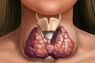 Наличие гипертиреоза Противопоказания