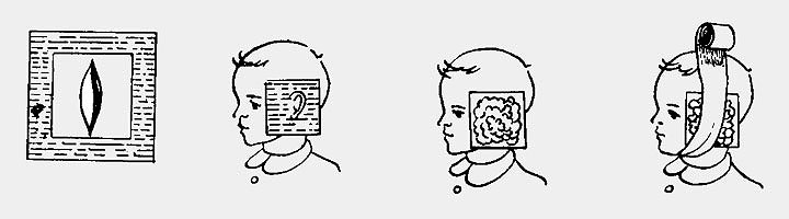 Методика применения фитопрепарата Согревающие компрессы