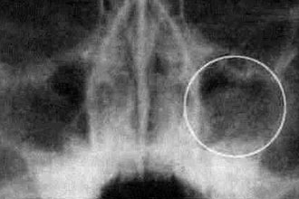 Опухоль гайморовой пазухи Опухоль гайморовой пазухи