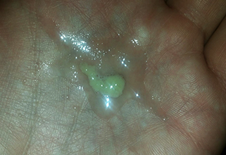 Слизь из горла Мокрота из горла