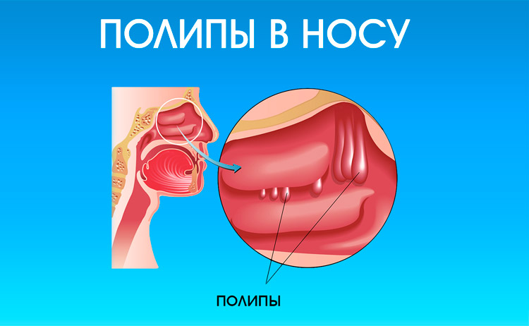Полипы в носу Назальный полипоз