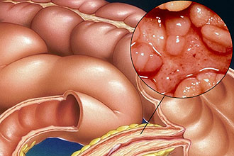 Болезни желудочно-кишечного тракта Причины возникновения