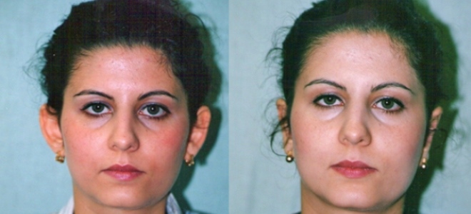 отопластика ушей