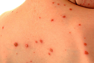 Ветряная оспа Ветрянка