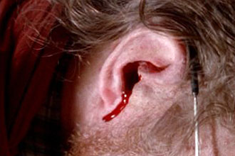Идет кровь из уха Идет кровь из уха