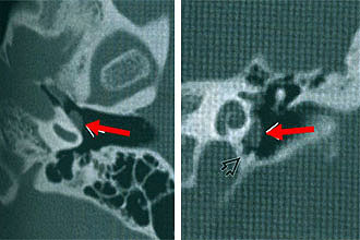 Параганглинома Параганглинома