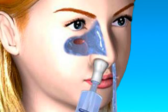 Промывание носа при насморке Промывание носа при насморке в домашних условиях