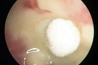 Отомикоз Микоз