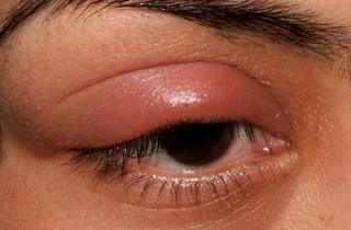 Отечность верхнего века со стороны воспаления говорит о наличии фронтита Симптомы фронтита