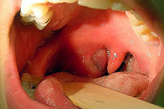 Ангина (острый тонзиллит) Что такое ангина