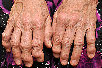 Ревматизм – наиболее распространенное осложнение Ревматизм