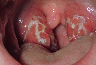 Тонзиллит Ангина